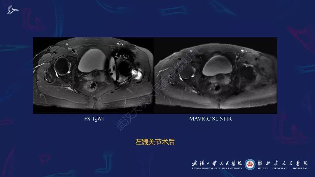 【PPT】肌骨MRI金属伪影抑制技术临床应用