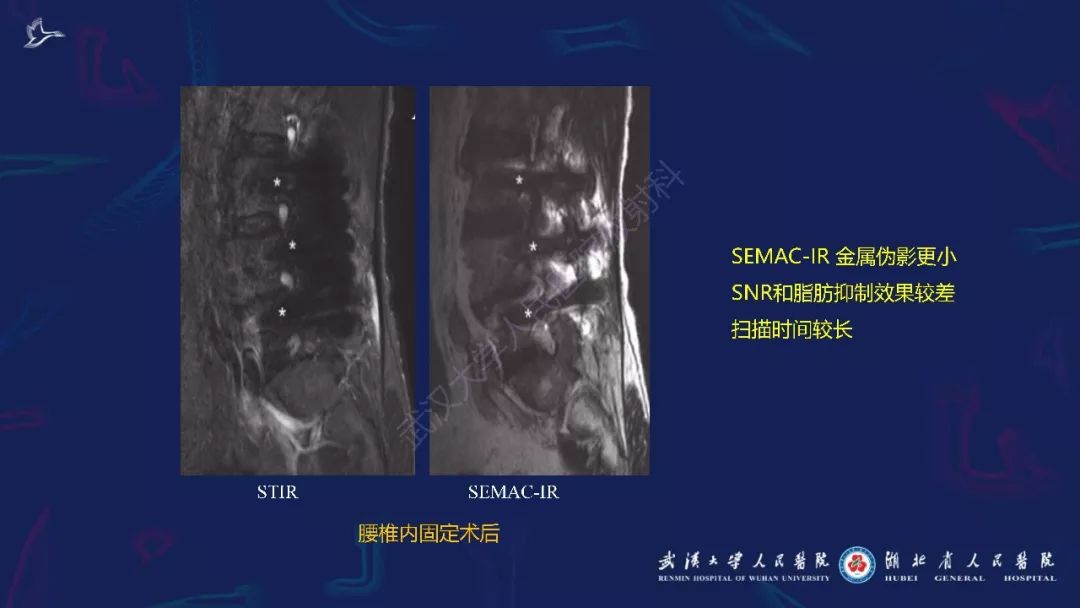 【PPT】肌骨MRI金属伪影抑制技术临床应用
