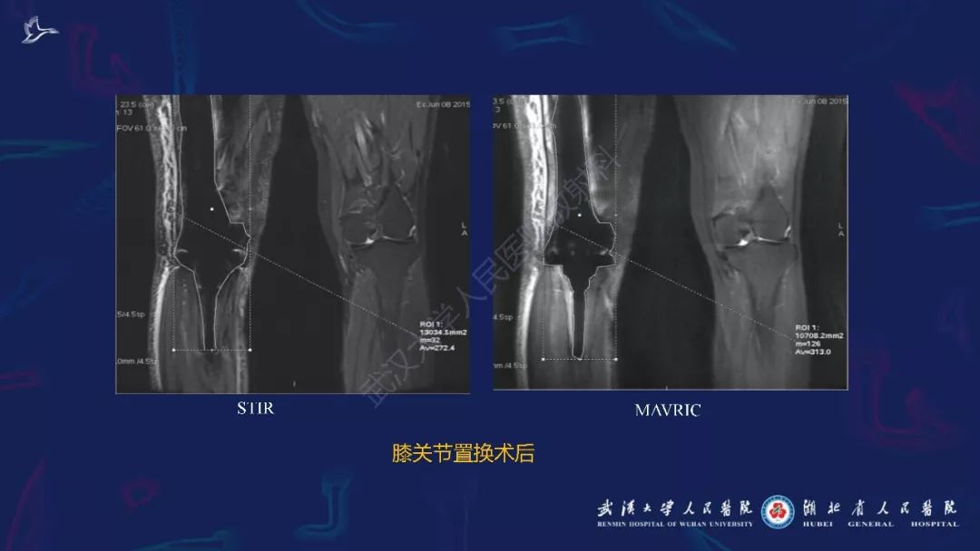 【PPT】肌骨MRI金属伪影抑制技术临床应用