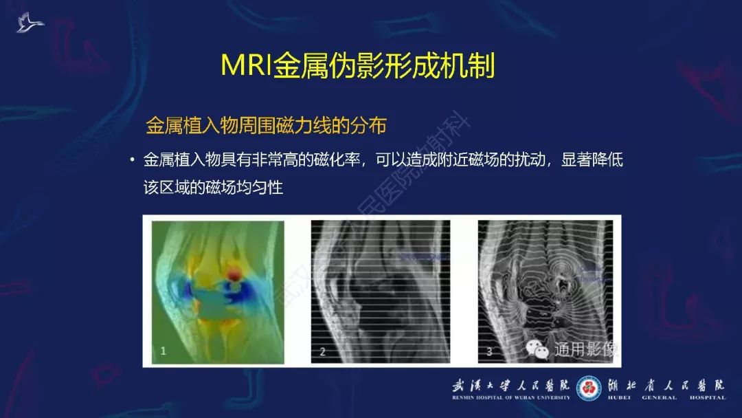 【PPT】肌骨MRI金属伪影抑制技术临床应用