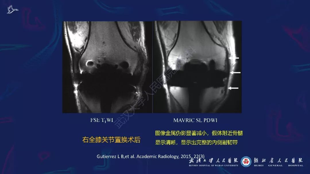【PPT】肌骨MRI金属伪影抑制技术临床应用
