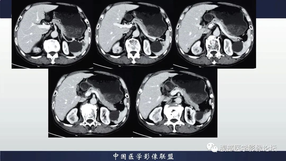 【病例】右肾嗜酸细胞腺瘤1例CT影像