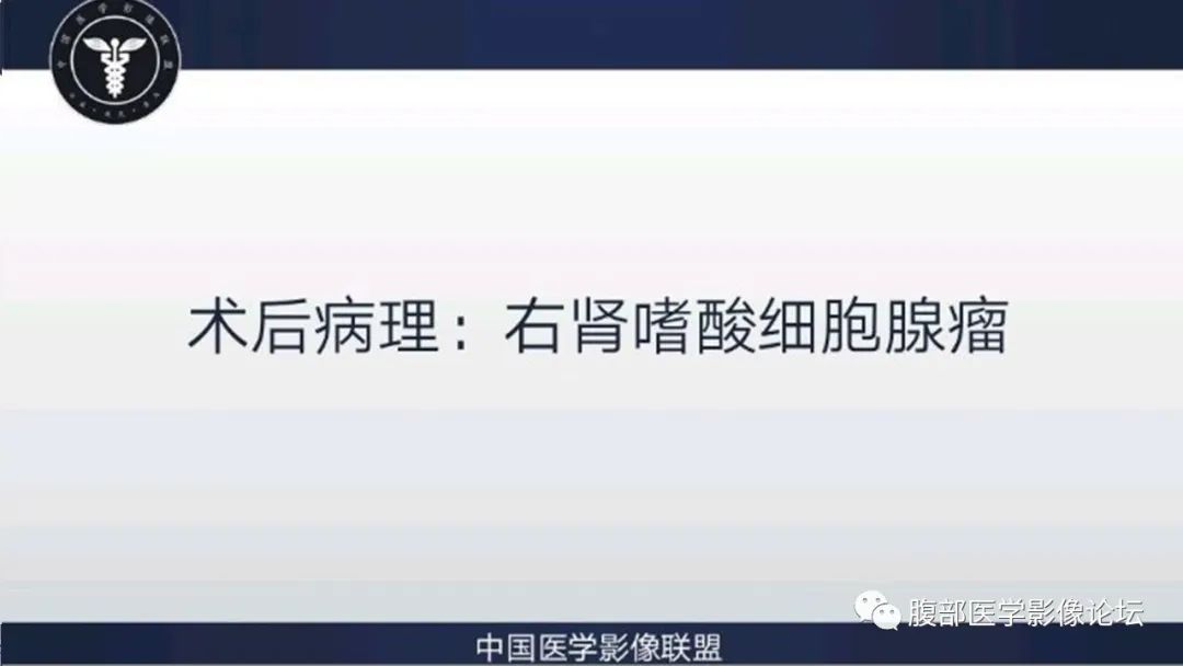 【病例】右肾嗜酸细胞腺瘤1例CT影像