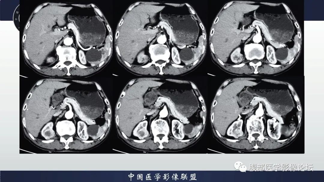 【病例】右肾嗜酸细胞腺瘤1例CT影像