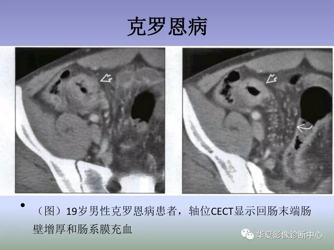 【PPT】回盲部占位或炎症的影像鉴别诊断