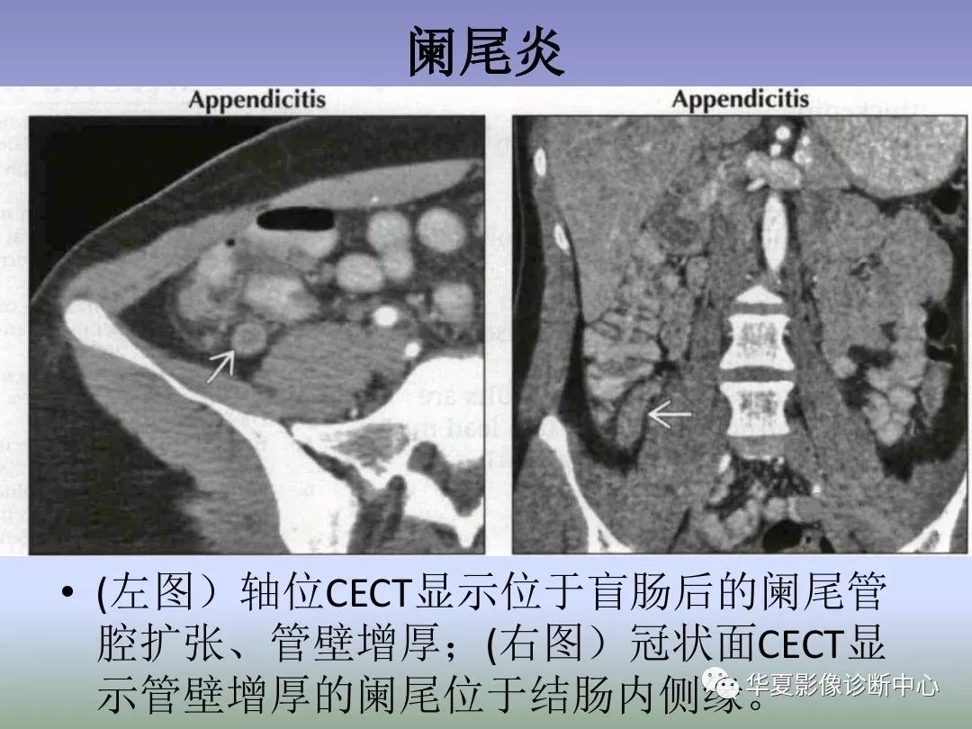 【PPT】回盲部占位或炎症的影像鉴别诊断