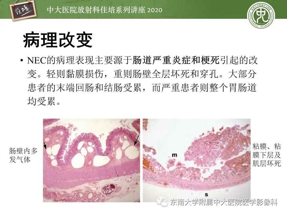 【PPT】新生儿坏死性小肠结肠炎的影像学表现