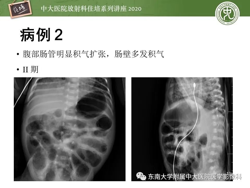 【PPT】新生儿坏死性小肠结肠炎的影像学表现