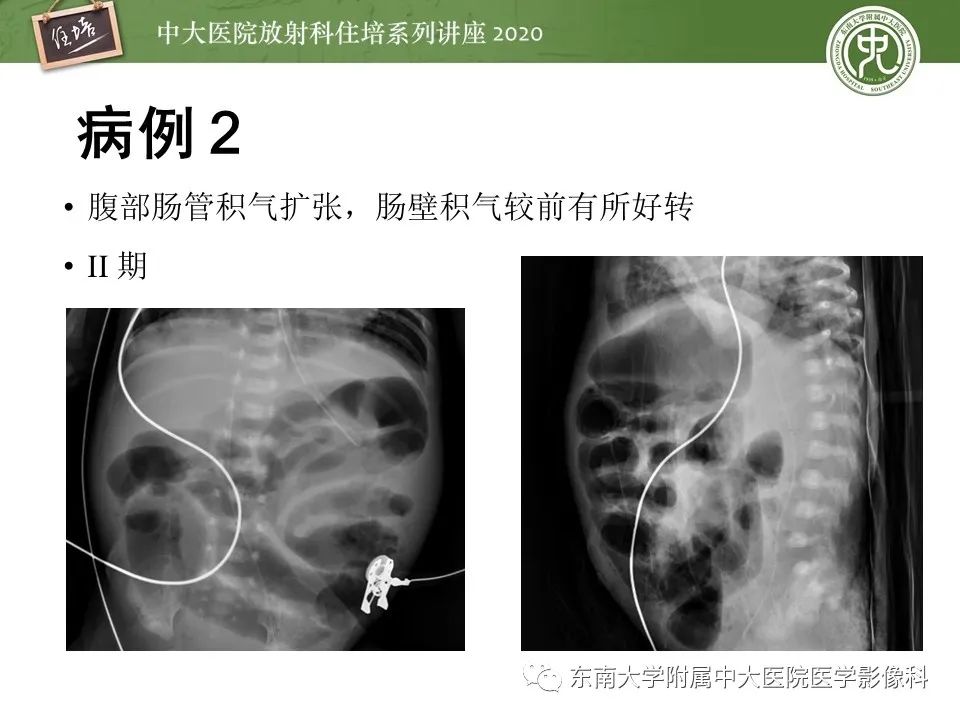 【PPT】新生儿坏死性小肠结肠炎的影像学表现