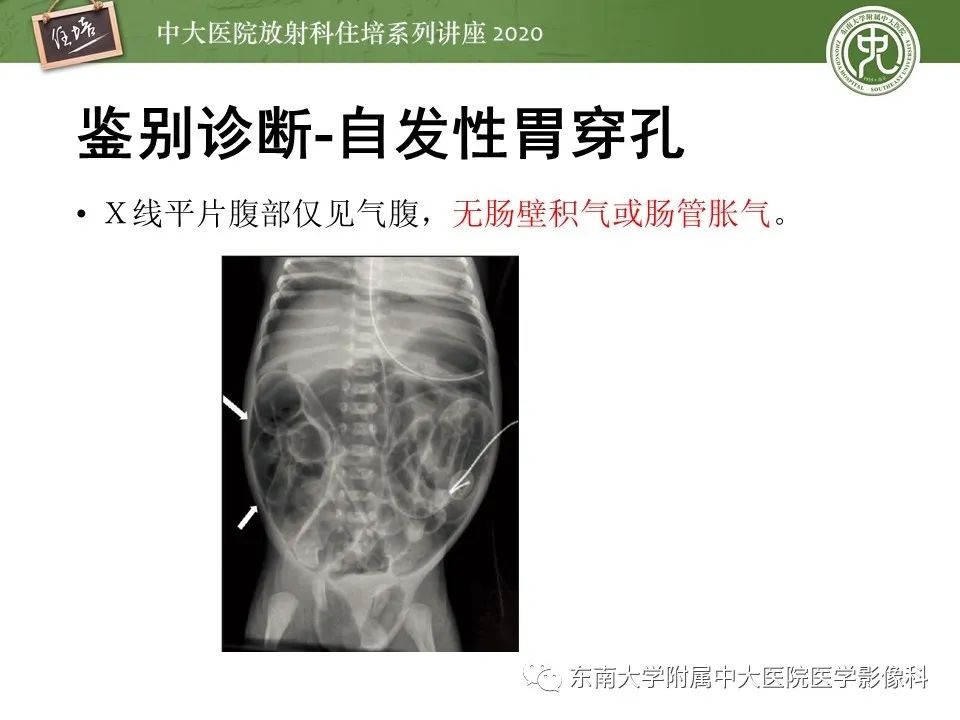 【PPT】新生儿坏死性小肠结肠炎的影像学表现