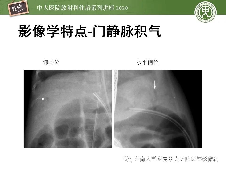 【PPT】新生儿坏死性小肠结肠炎的影像学表现