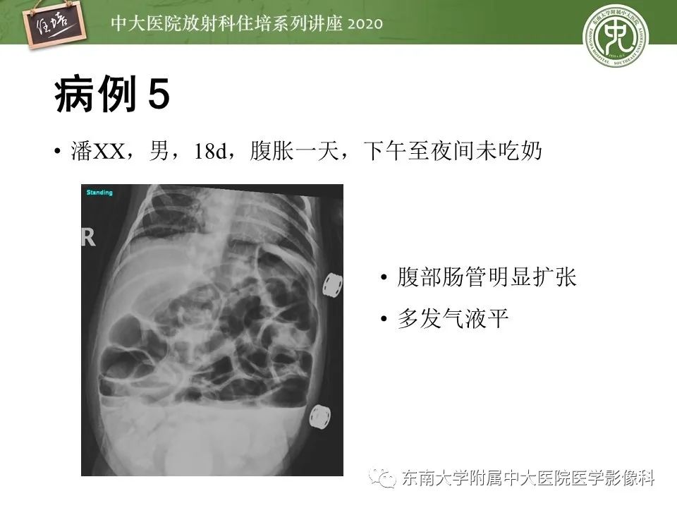 【PPT】新生儿坏死性小肠结肠炎的影像学表现