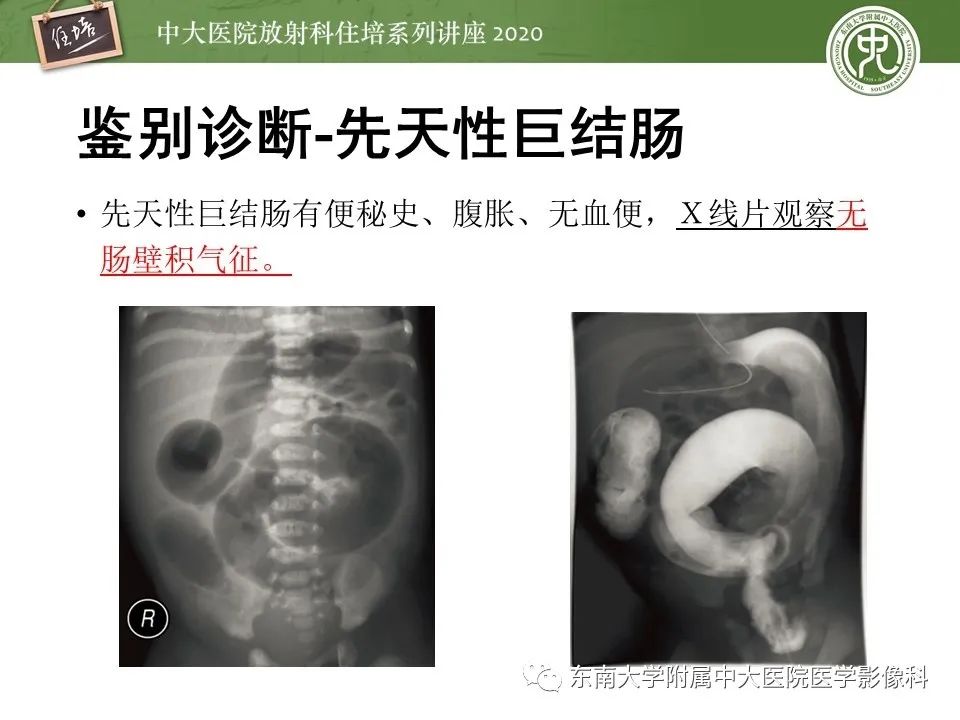【PPT】新生儿坏死性小肠结肠炎的影像学表现