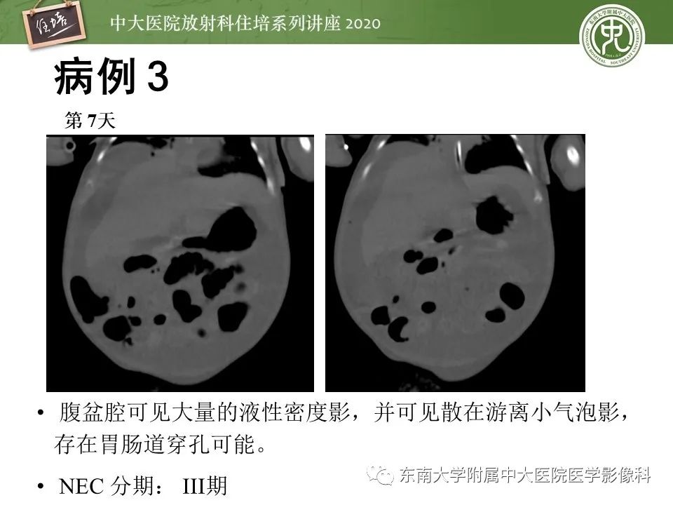 【PPT】新生儿坏死性小肠结肠炎的影像学表现