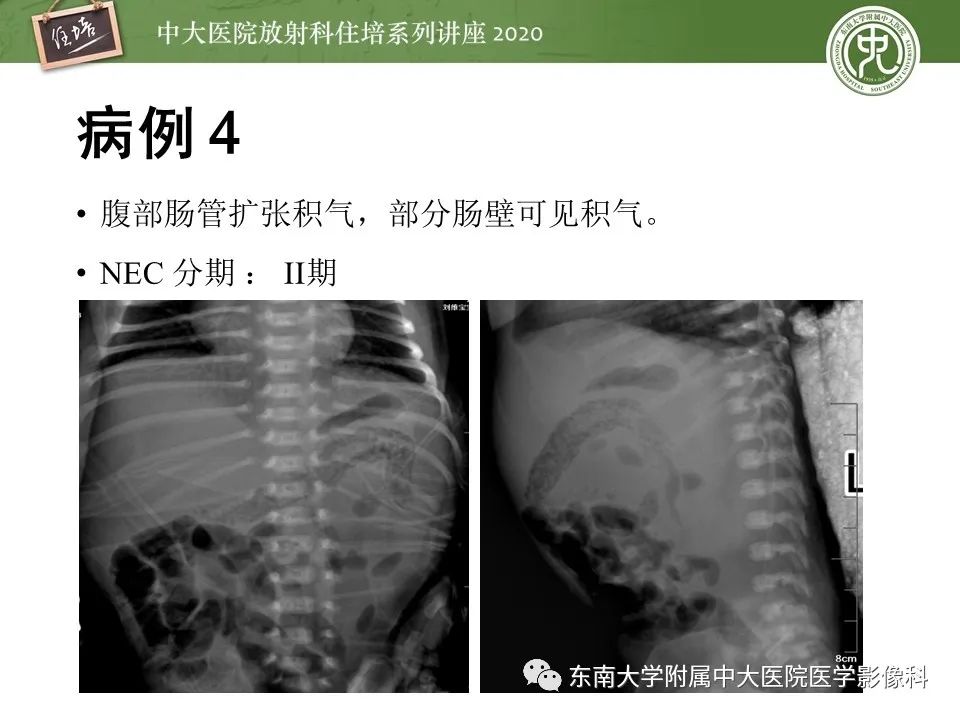 【PPT】新生儿坏死性小肠结肠炎的影像学表现