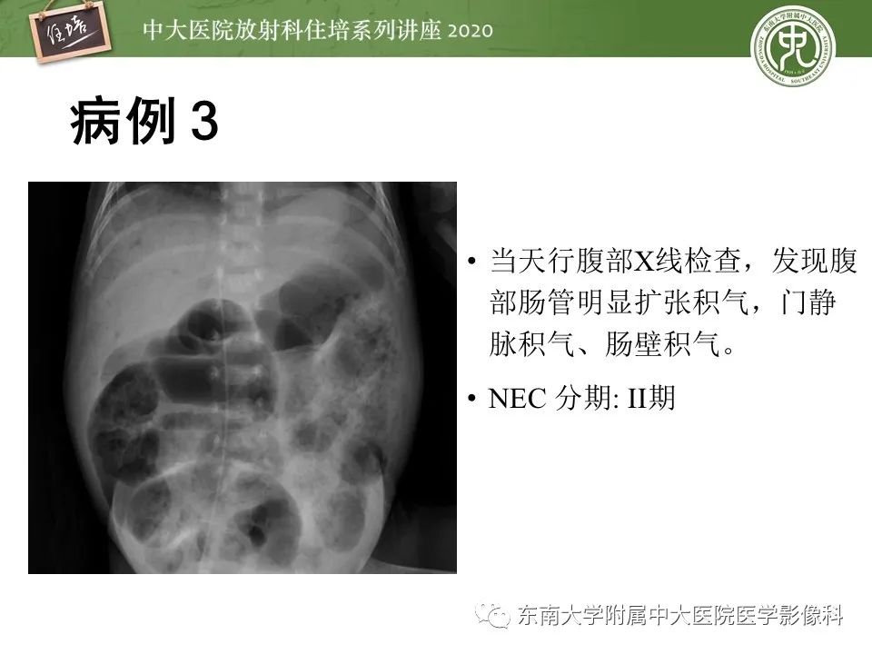 【PPT】新生儿坏死性小肠结肠炎的影像学表现