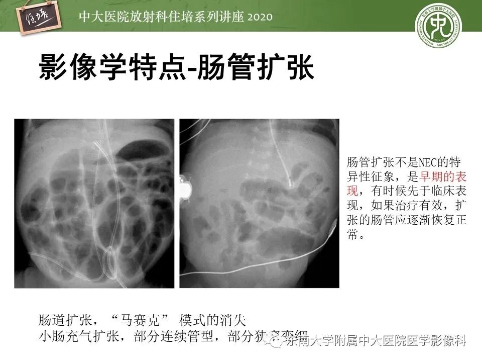 【PPT】新生儿坏死性小肠结肠炎的影像学表现