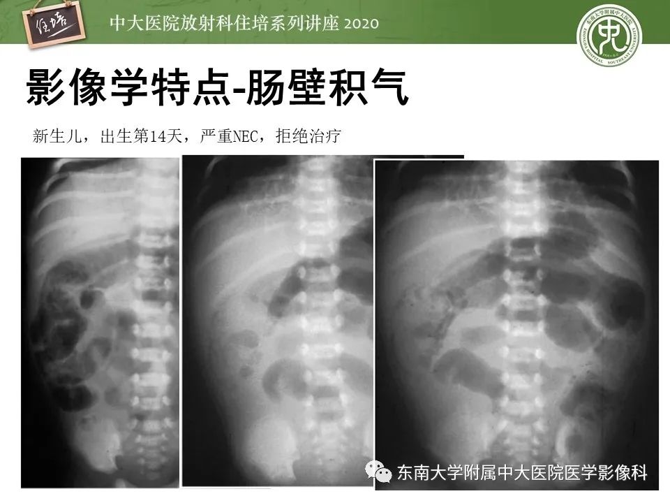 【PPT】新生儿坏死性小肠结肠炎的影像学表现