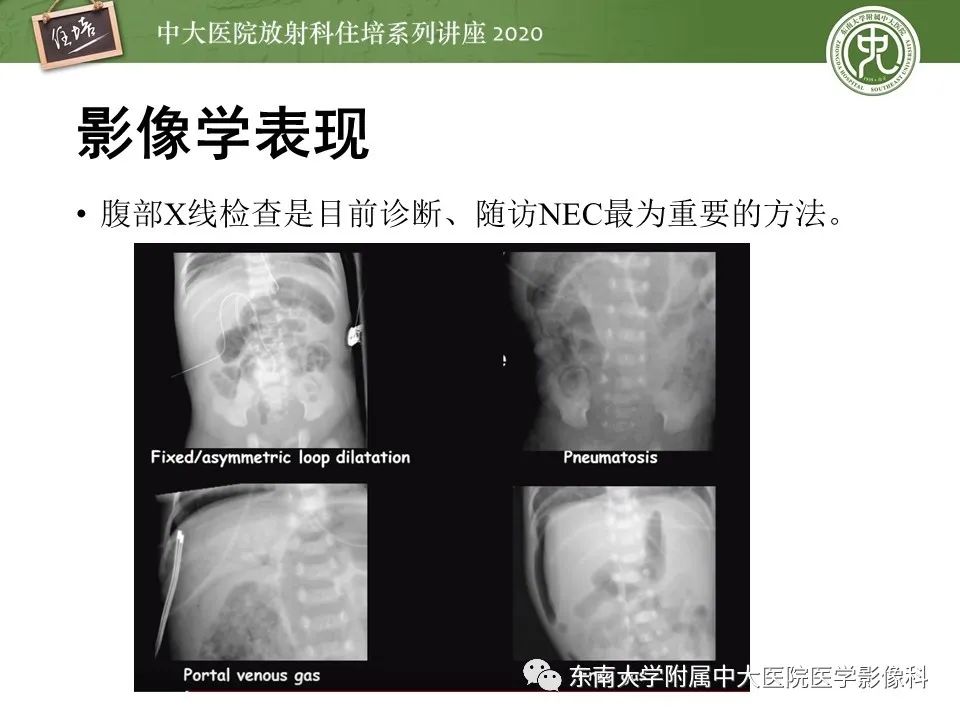【PPT】新生儿坏死性小肠结肠炎的影像学表现