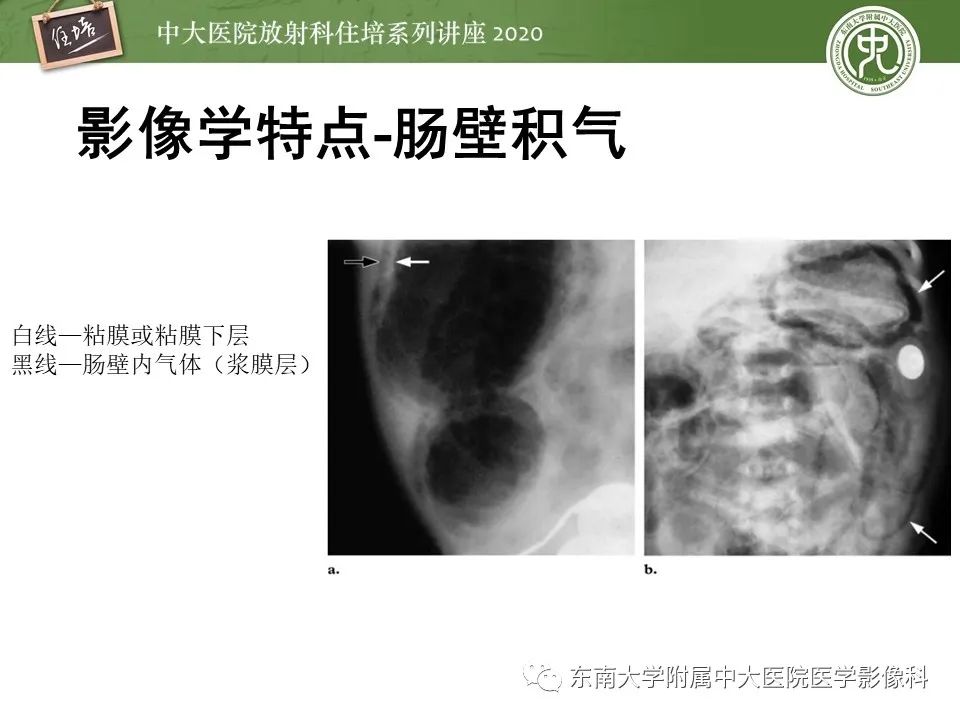 【PPT】新生儿坏死性小肠结肠炎的影像学表现