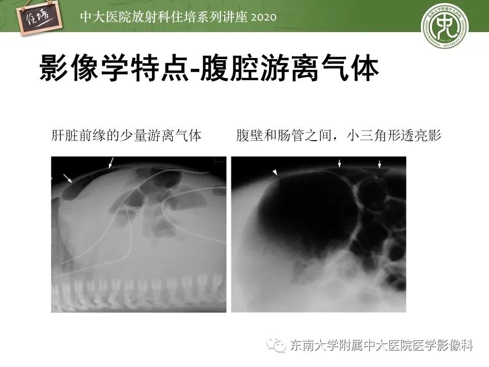 【PPT】新生儿坏死性小肠结肠炎的影像学表现