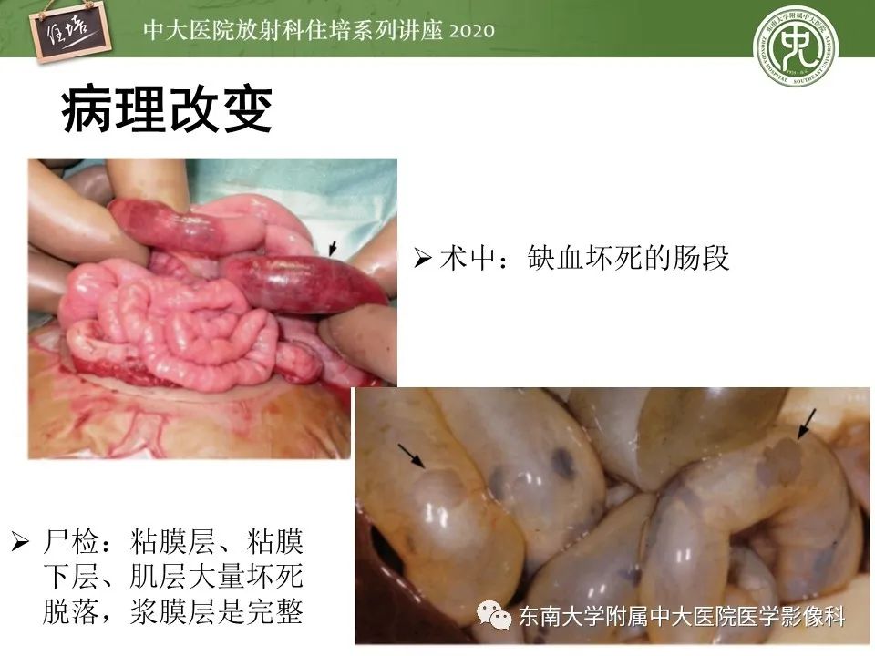 新生儿坏死性小肠结肠炎的影像学表现