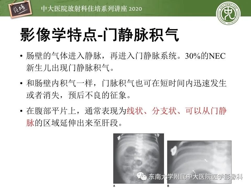 【PPT】新生儿坏死性小肠结肠炎的影像学表现
