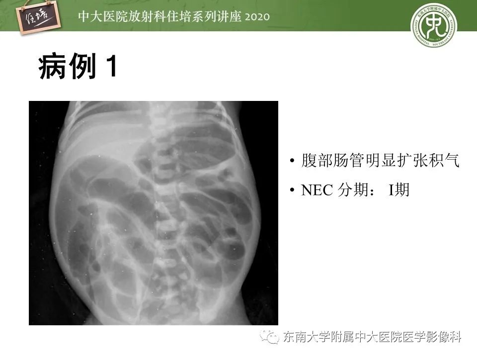 【PPT】新生儿坏死性小肠结肠炎的影像学表现
