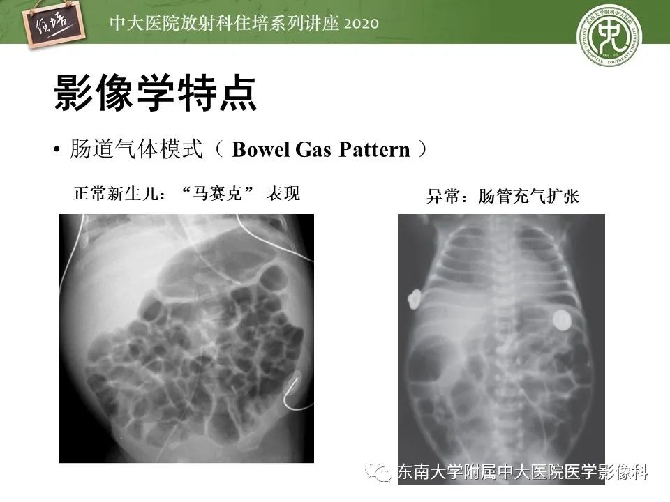 【PPT】新生儿坏死性小肠结肠炎的影像学表现