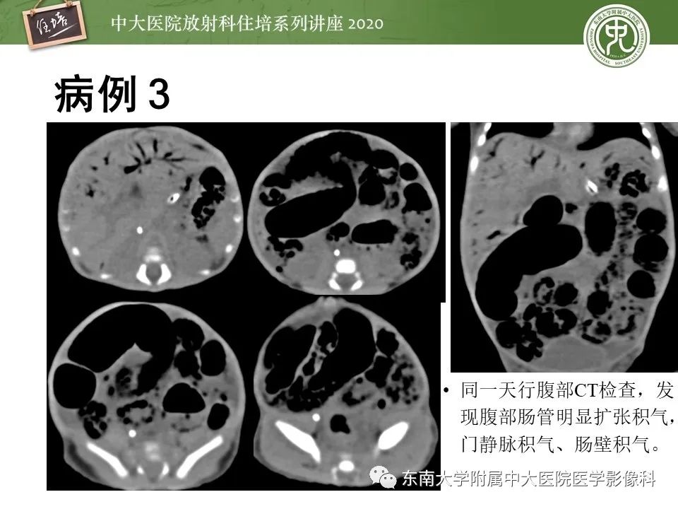 【PPT】新生儿坏死性小肠结肠炎的影像学表现