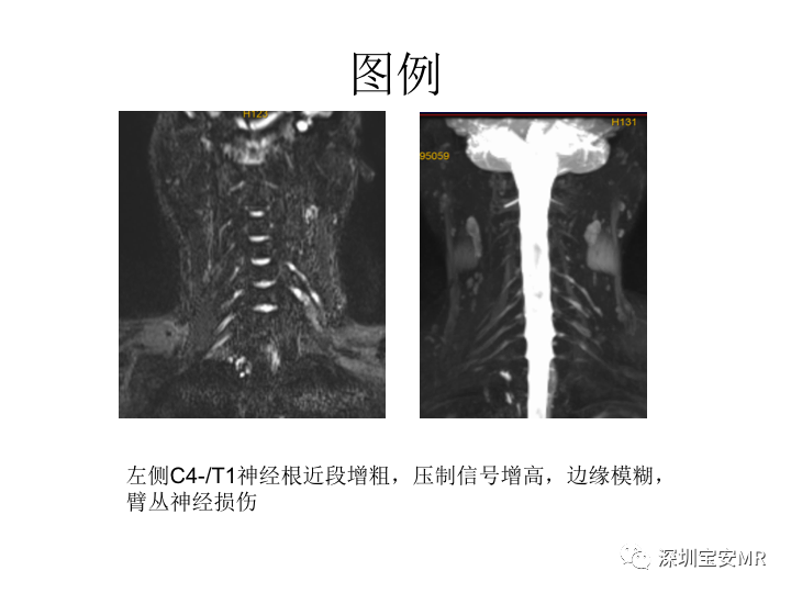 【PPT】臂丛神经MR扫描