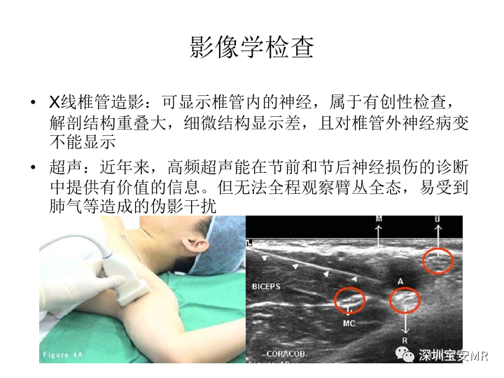 【PPT】臂丛神经MR扫描