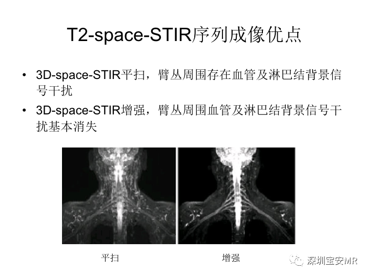 【PPT】臂丛神经MR扫描