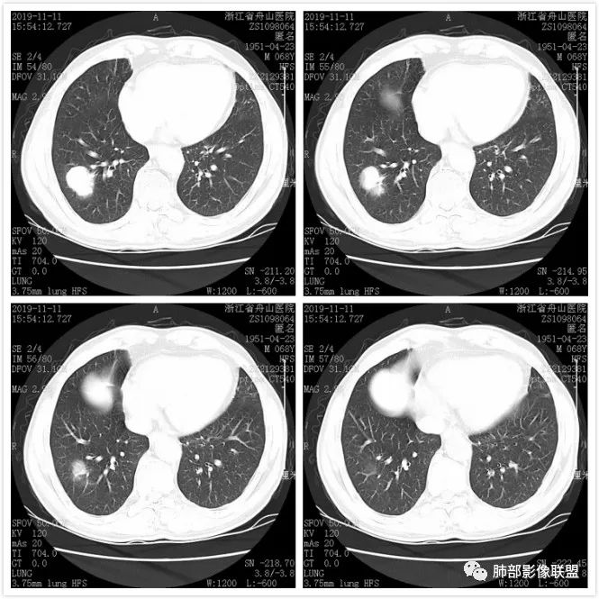 【病例】诡异的尿路肺转移瘤1例CT影像
