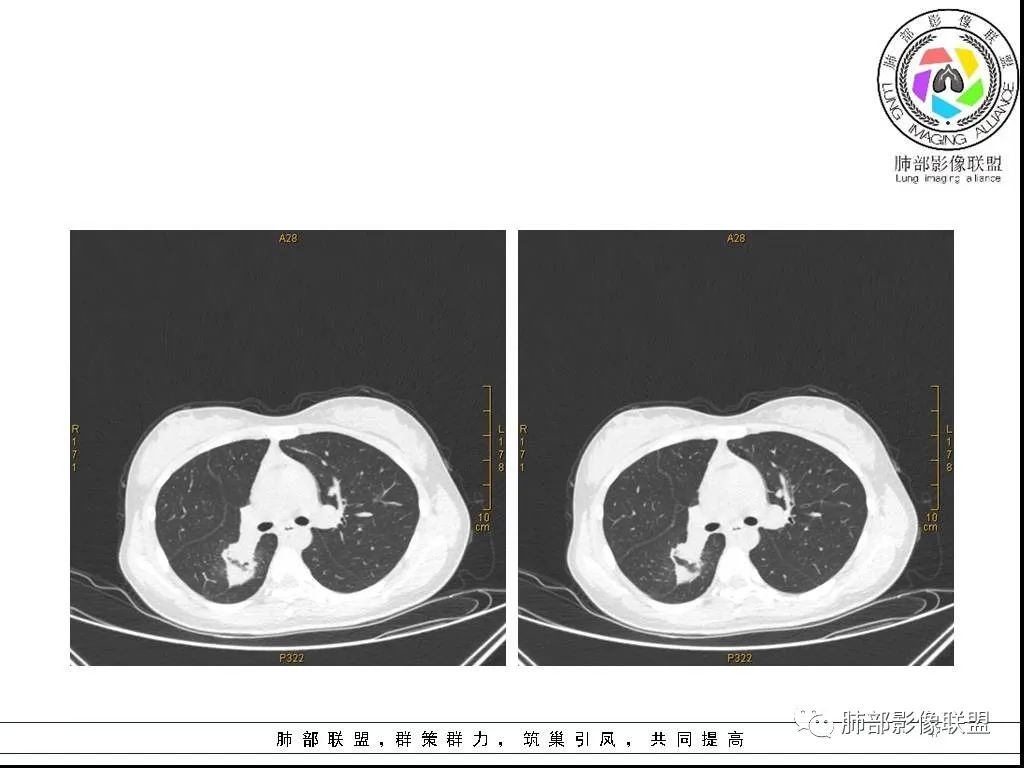 【病例】右肺炎症性病变1例CT影像讨论