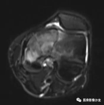 【病例】股骨下端骨巨细胞瘤1例CT及MR影像表现