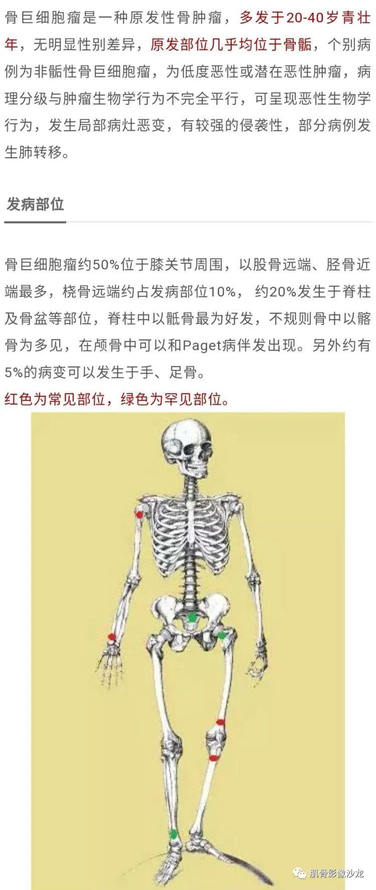 【病例】股骨下端骨巨细胞瘤1例CT及MR影像表现