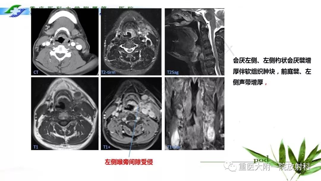 【PPT】咽部解剖及T分期影像诊断