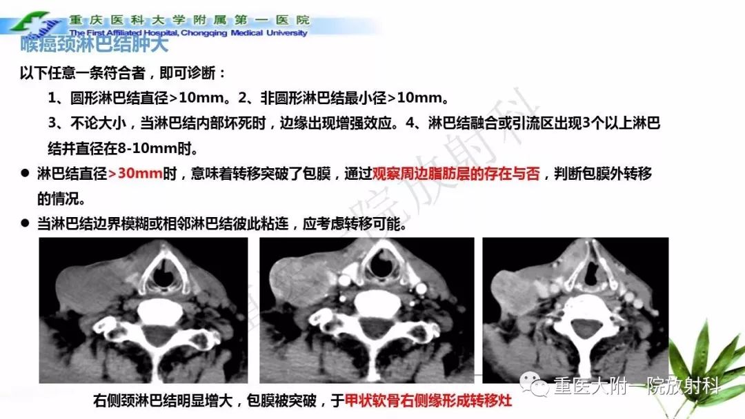 【PPT】咽部解剖及T分期影像诊断