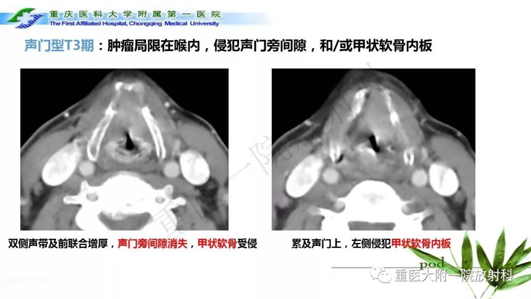 【PPT】咽部解剖及T分期影像诊断