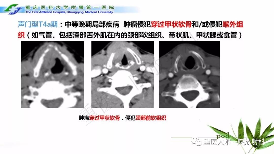 【PPT】咽部解剖及T分期影像诊断