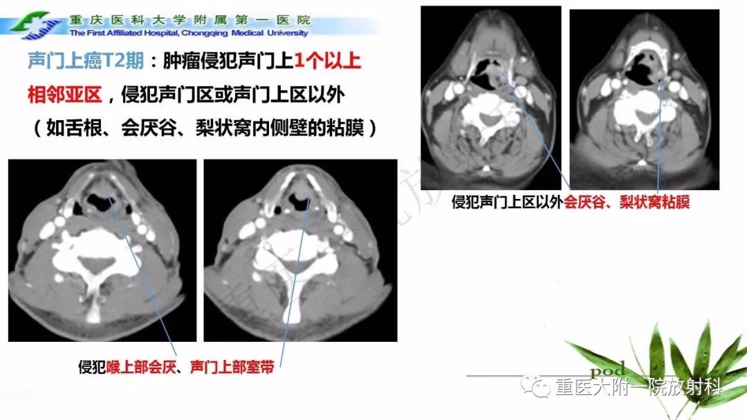 【PPT】咽部解剖及T分期影像诊断