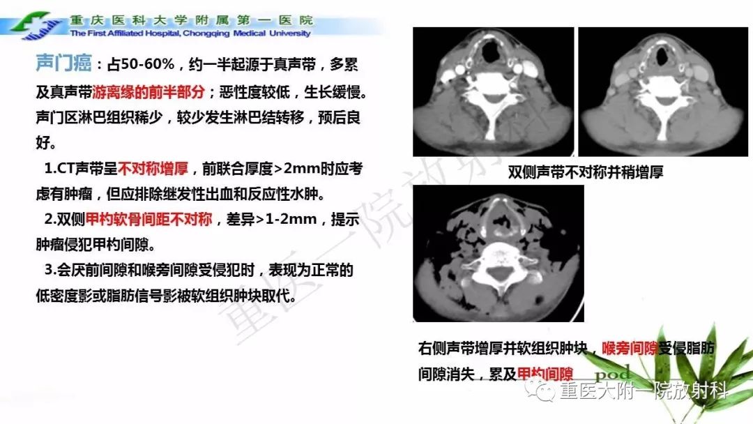 【PPT】咽部解剖及T分期影像诊断