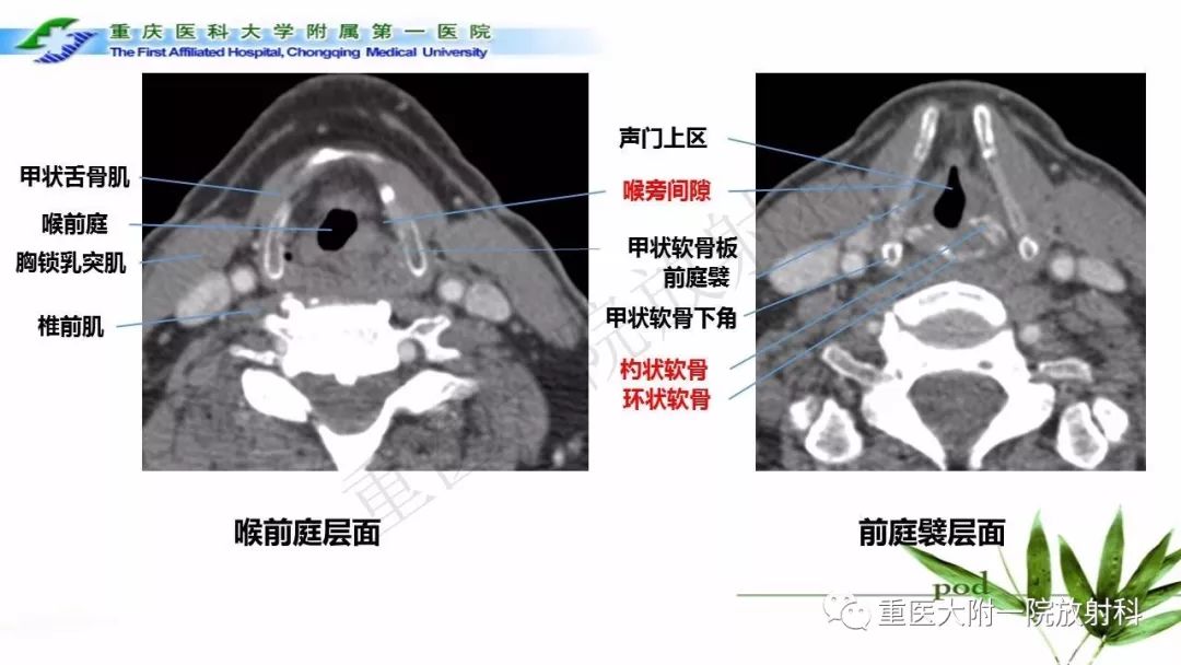 【PPT】咽部解剖及T分期影像诊断