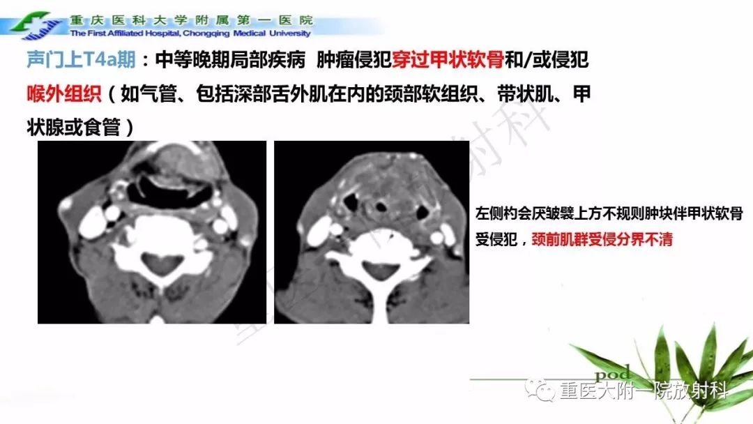 【PPT】咽部解剖及T分期影像诊断