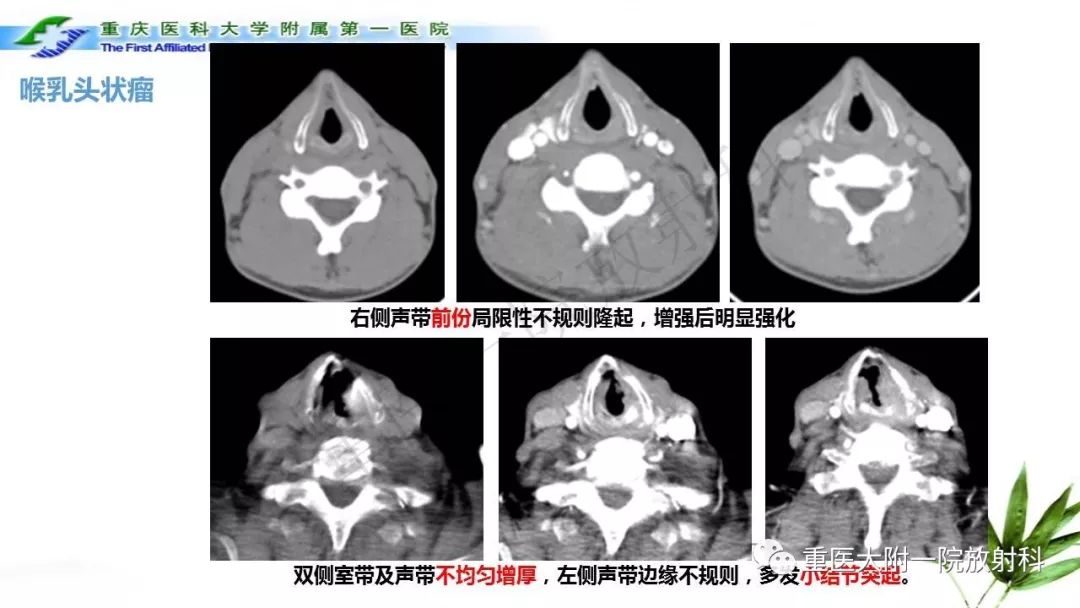 【PPT】咽部解剖及T分期影像诊断