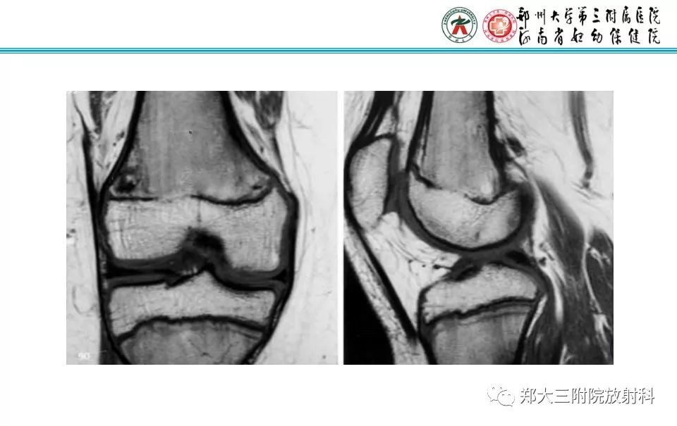 【PPT】骨骺损伤的影像诊断