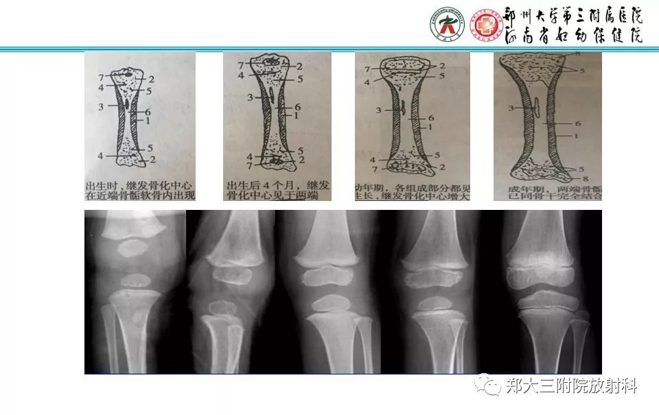【PPT】骨骺损伤的影像诊断