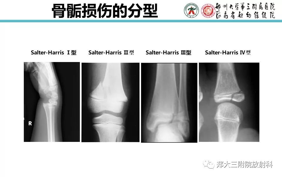 【PPT】骨骺损伤的影像诊断