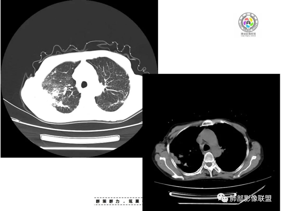 【病例】肺结核1例CT影像讨论
